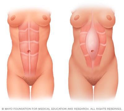 Diastasis recti, (Abdominal Muscle Separation) - Belly Bands