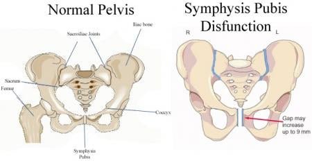 Exercise – Symphysis Pubic Dysfunction (SPD) - Belly Bands