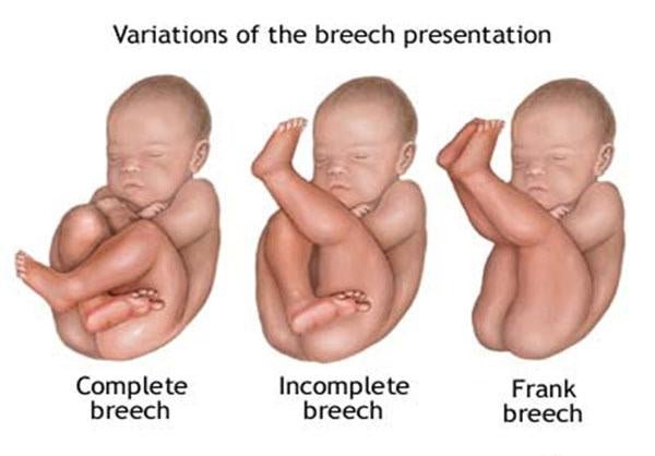 Exercise - Turn Your Baby From A Breech Position - Belly Bands