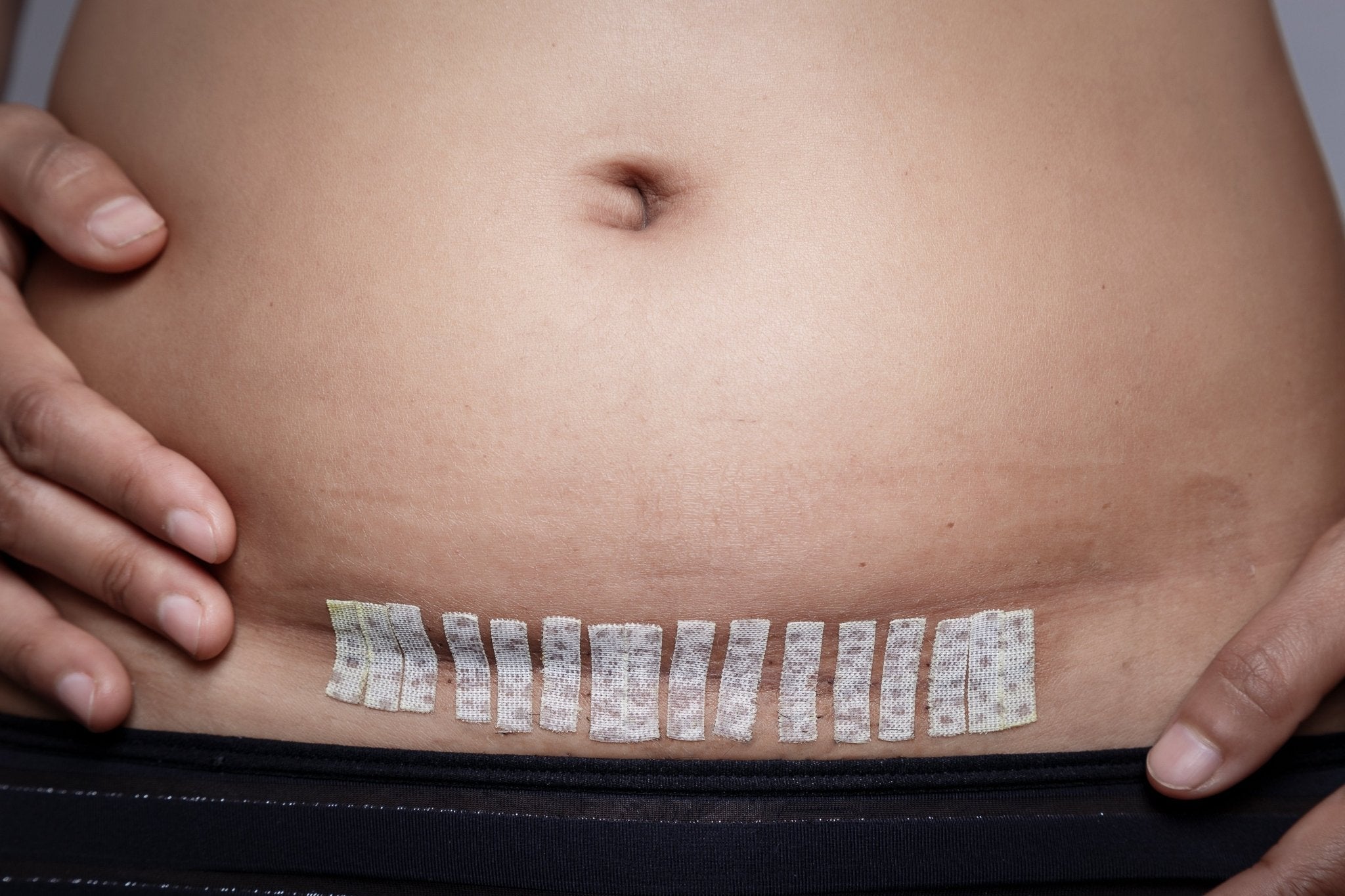 What To Expect Post C-Section Delivery - Belly Bands