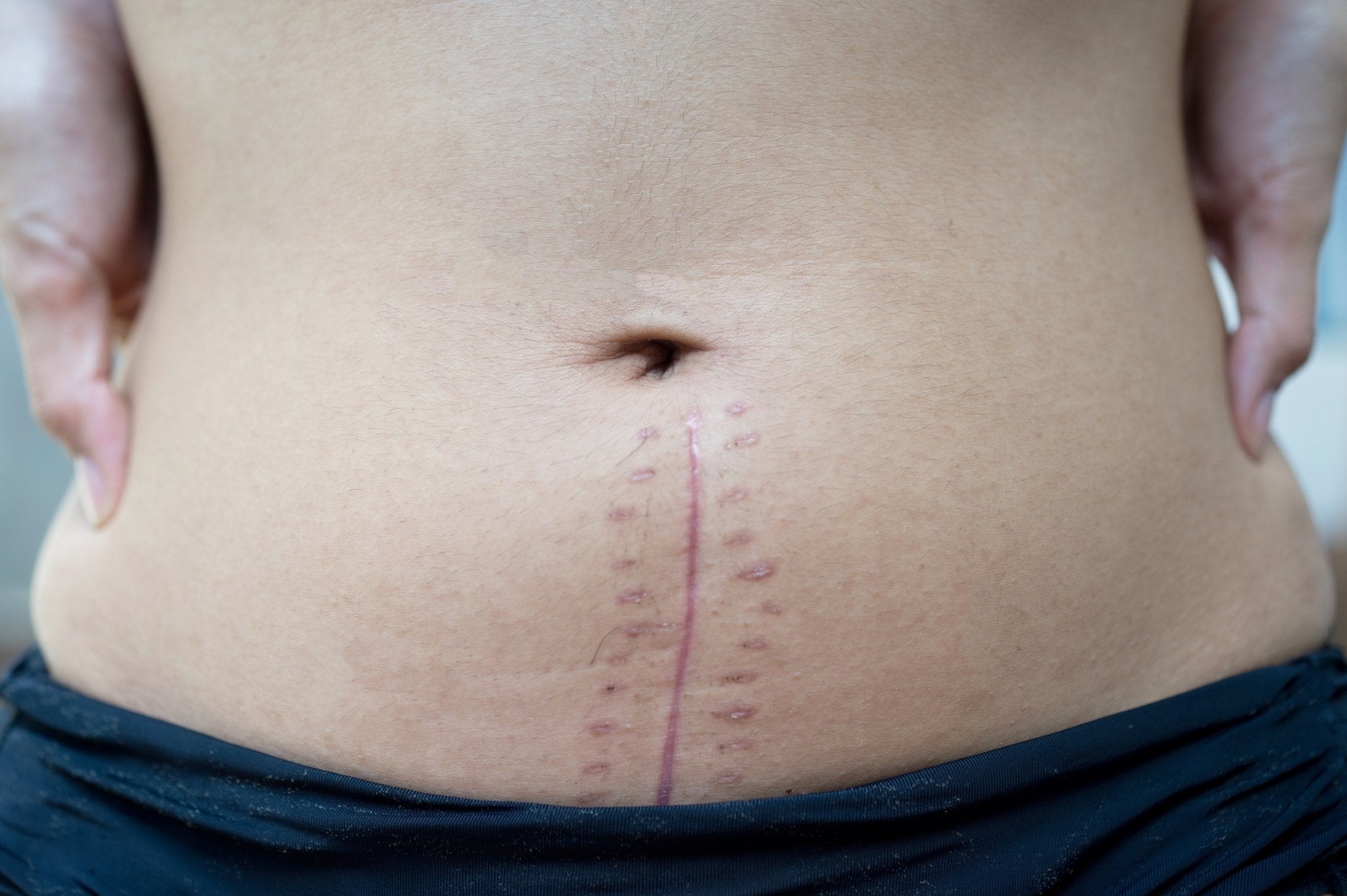 What To Expect With A Hysterectomy - Belly Bands